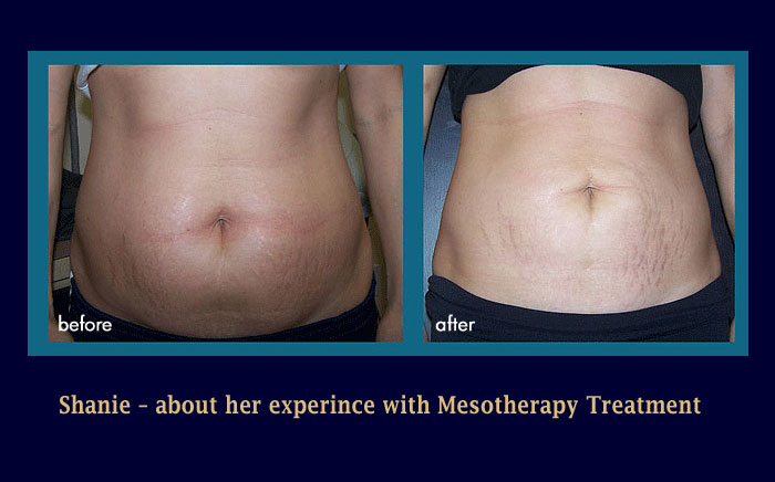 Mesotherapy Brevard